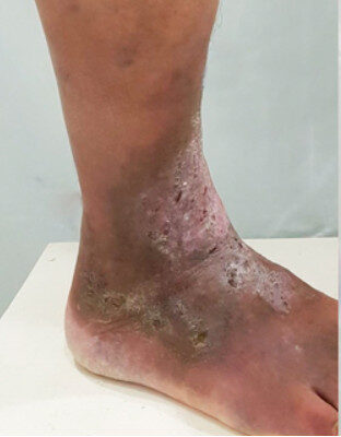 feridas escures podem ser popularmente chamadas de Maria preta