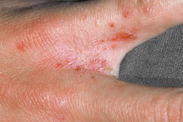 #Série - Nomes populares de doenças na Amazônia: o que é curuba?